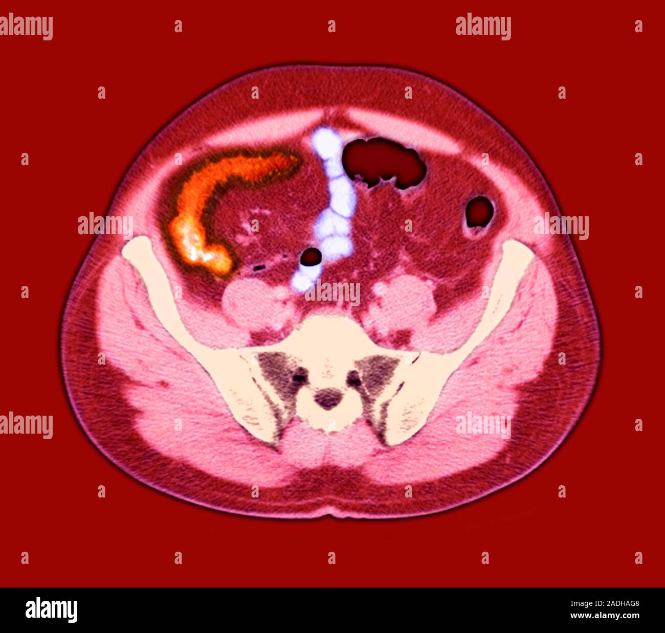 Crohn's disease. Axial coloured resonance imaging (MRI) scan