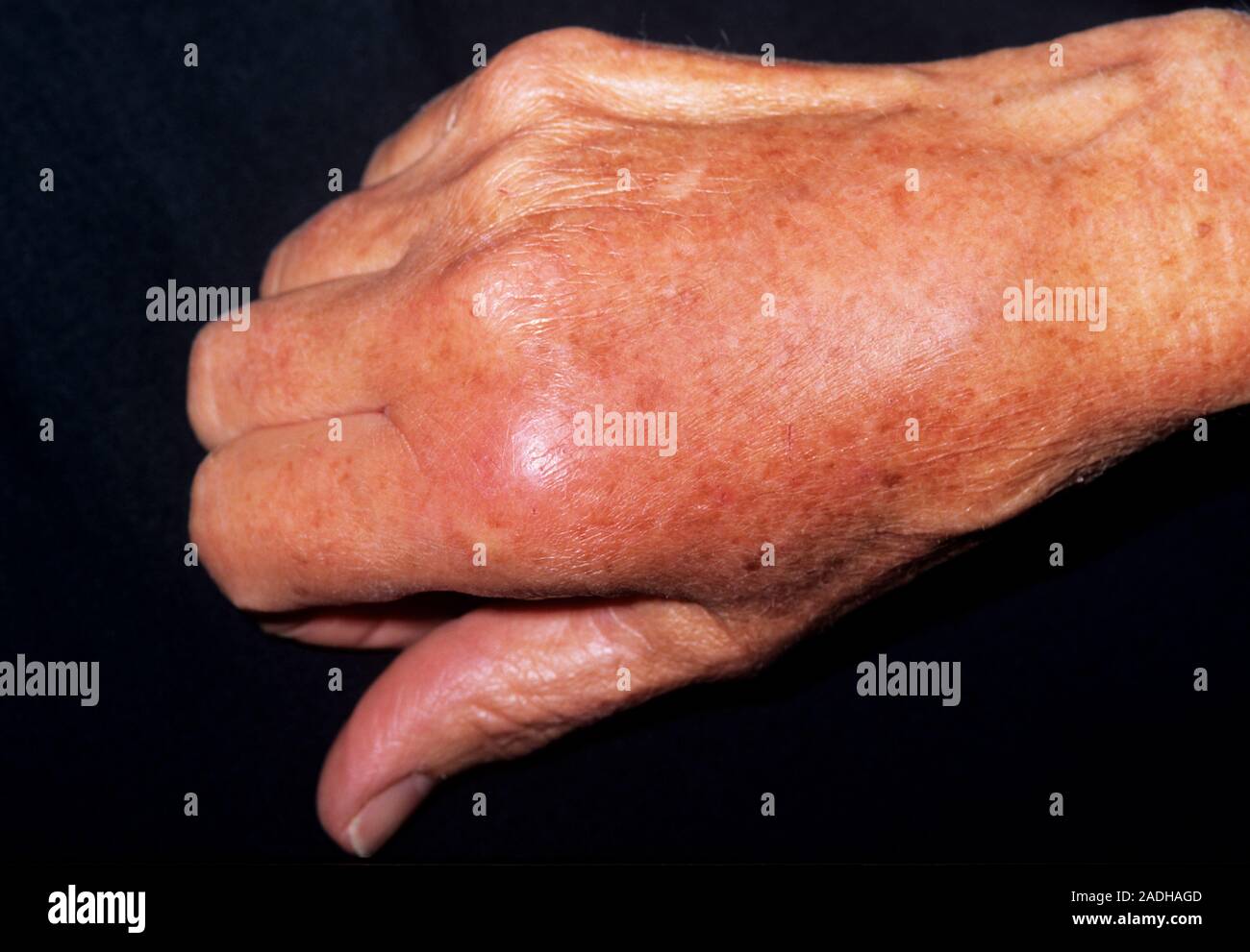 Cellulitis in a 90yearold woman's knuckle, caused by catching her