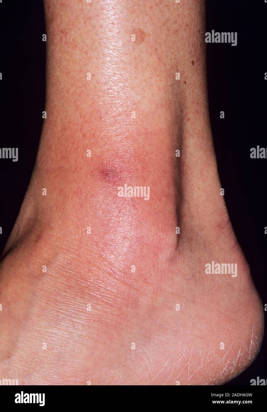 Cellulitis on a 46yearold woman's ankle, caused by an insect bite (dark red, centre
