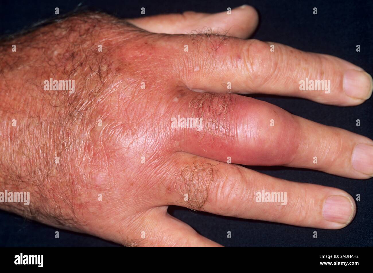 Cellulitis on a 74yearold man's hand caused by catching his hand on a