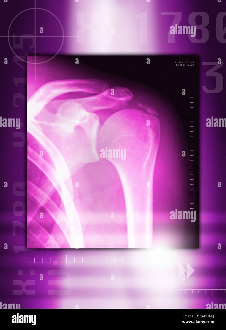 Calcified shoulder joint. Coloured Xray of a calcified shoulder joint