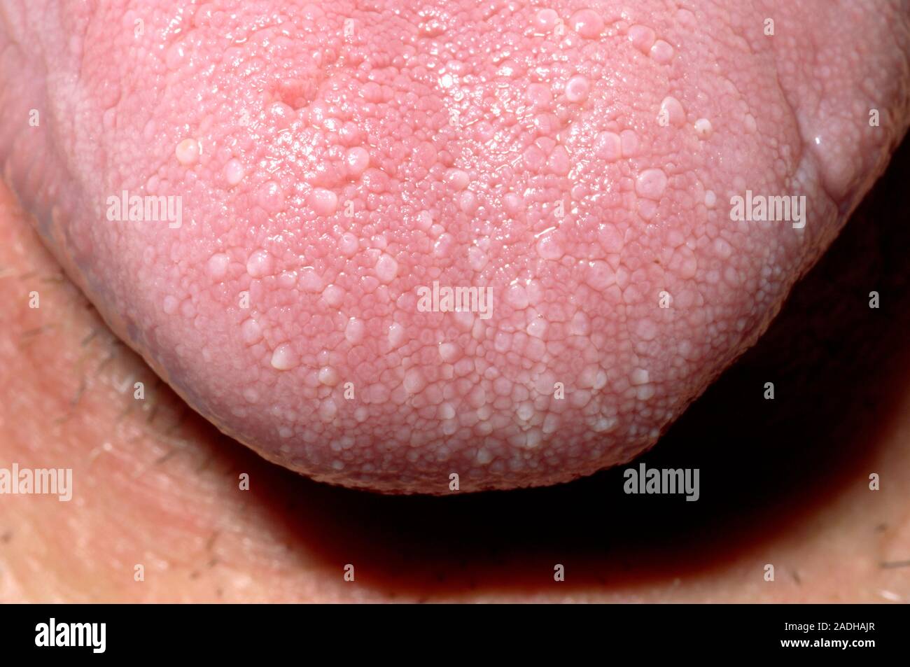 Fungus 2024 on tongue