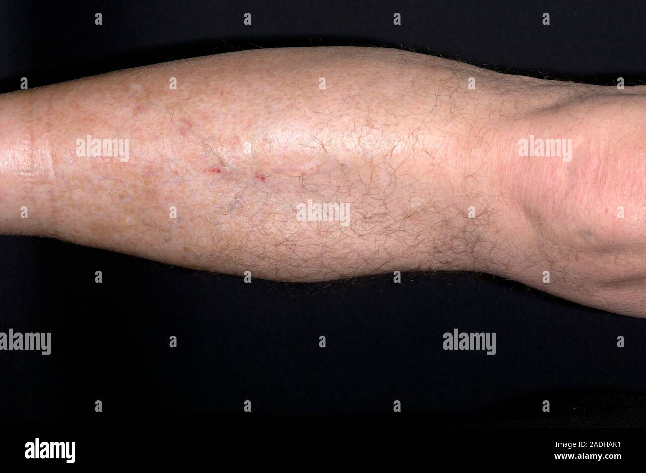 Swollen leg of a 72 year old man caused by a ruptured baker's cyst. A