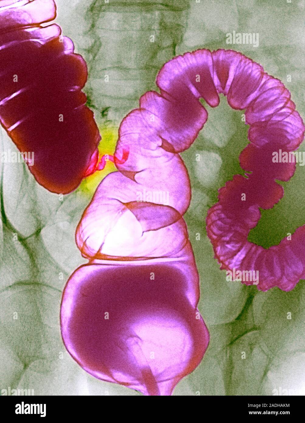 Colonic spasm. Double contrast coloured Xray of a spasm in the large