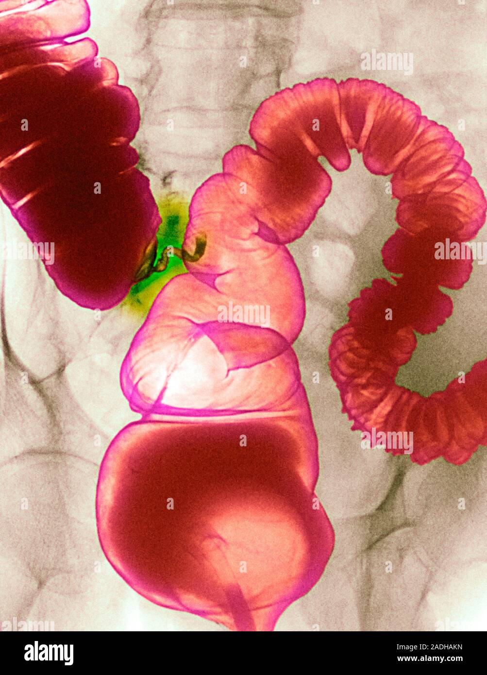 Colonic spasm. Double contrast coloured Xray of a spasm in the large
