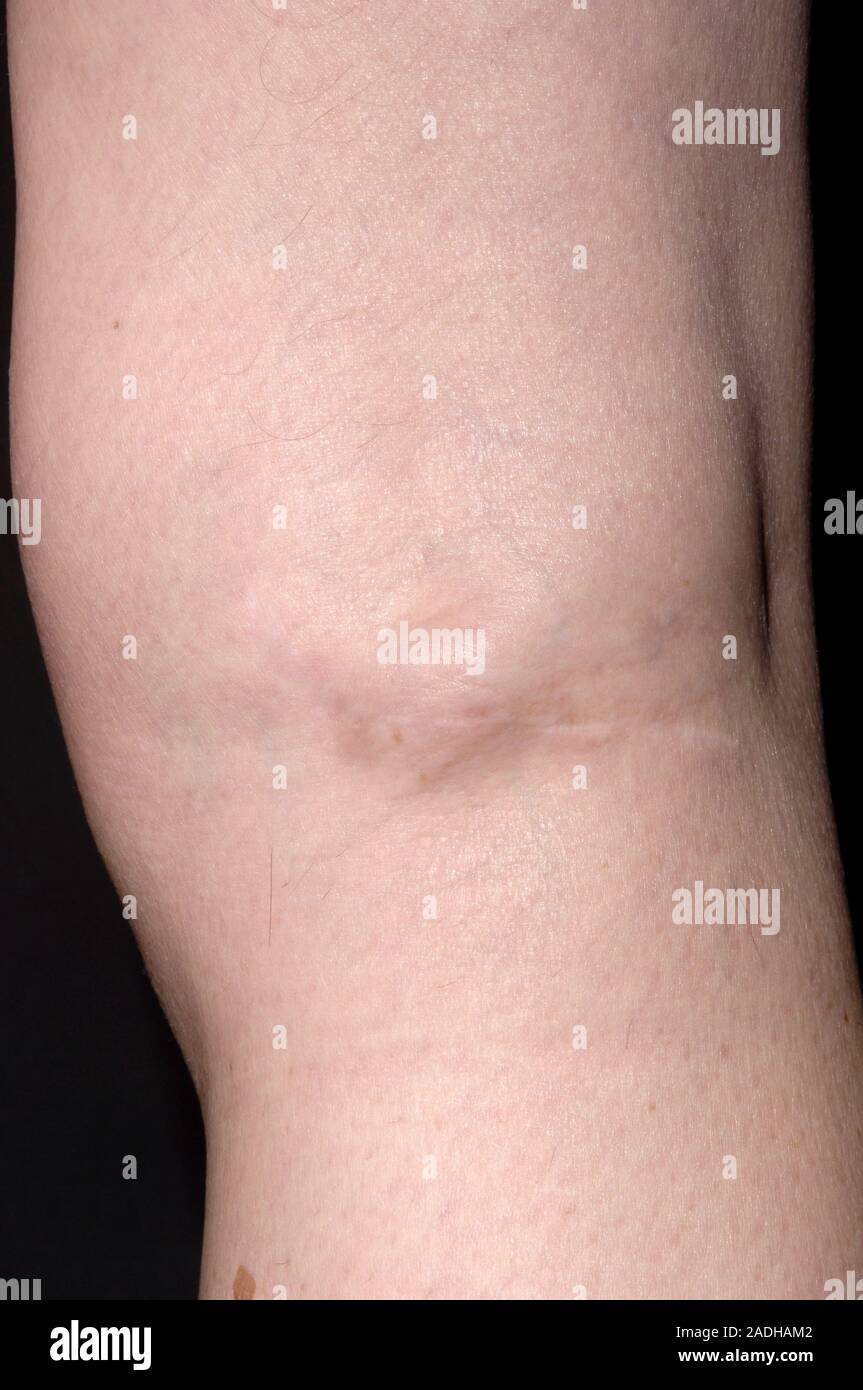 Baker's cyst (lump, centre) on the back of a 73-year-old woman's knee ...