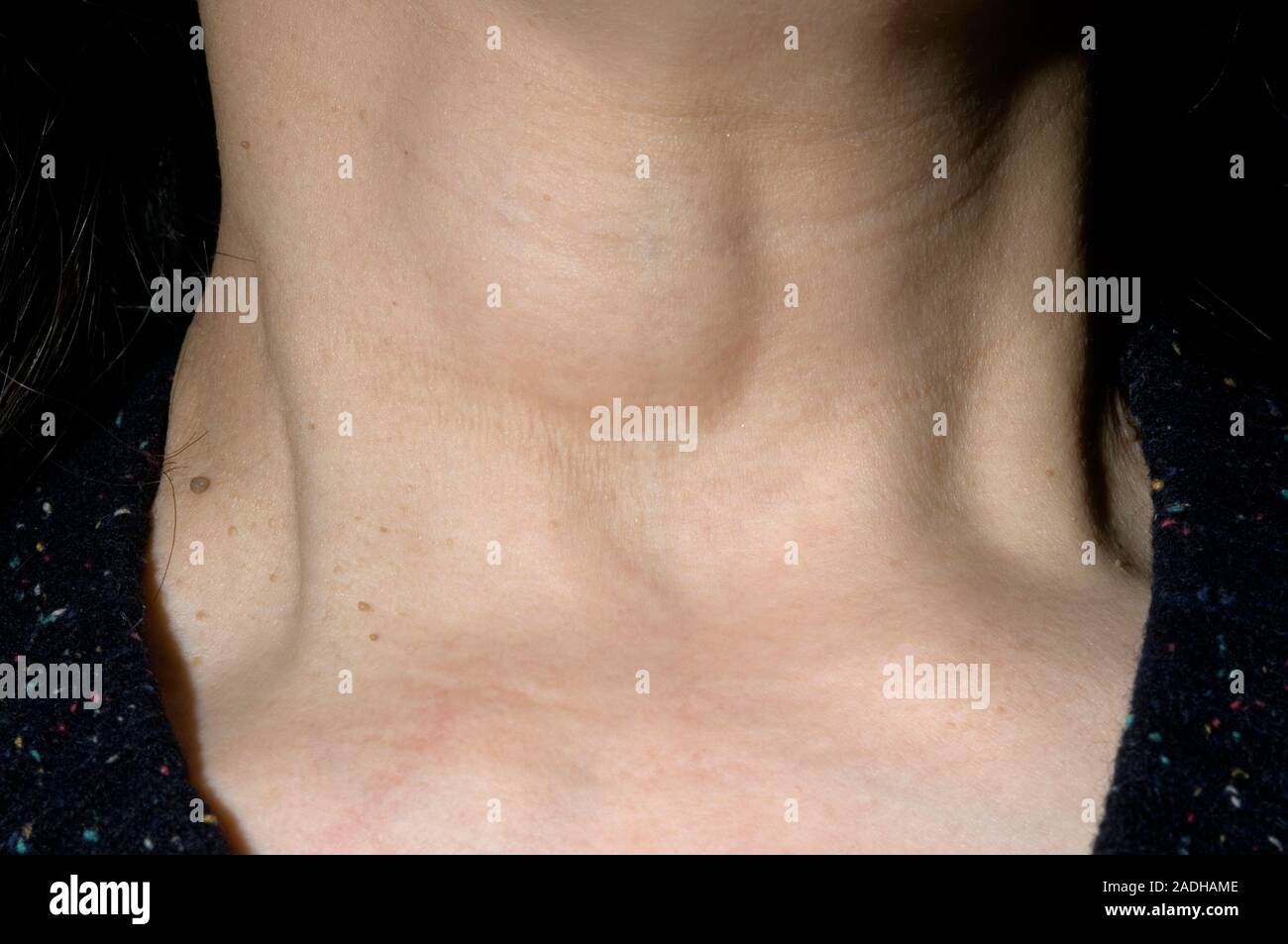 Thyroid cyst in a 53 year old woman. A cyst is a fluidfilled sac