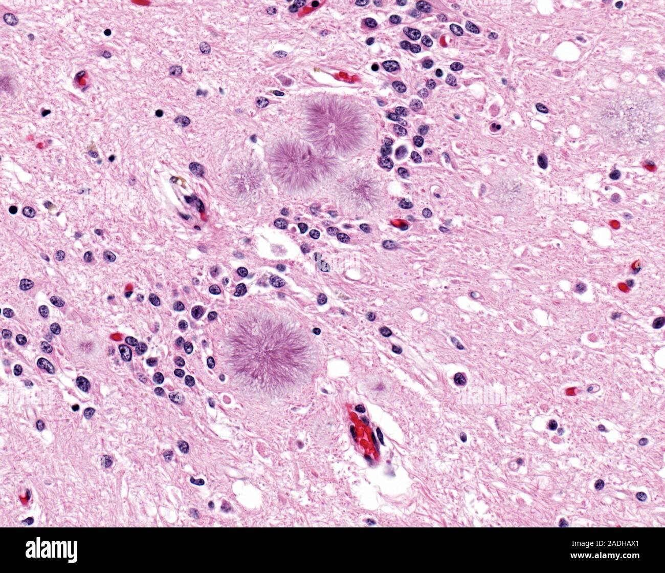 CreutzfeldtJakob disease. Light micrograph of a section through a
