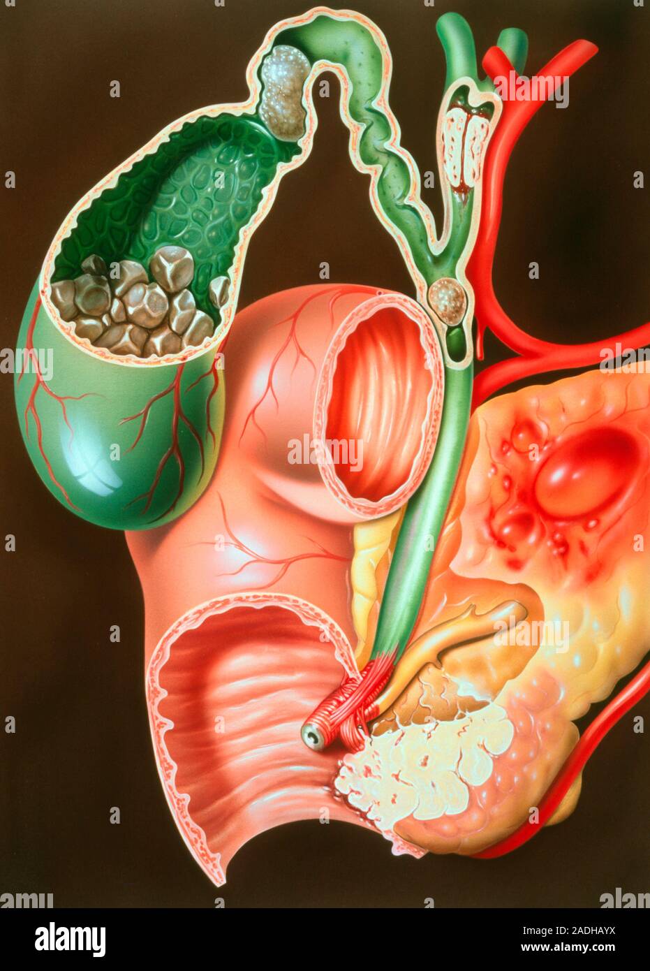 Диетотерапия при остром холецистите. Холецистит творог. Диета при холецистите. Холецистит творог. Холецистит творог.