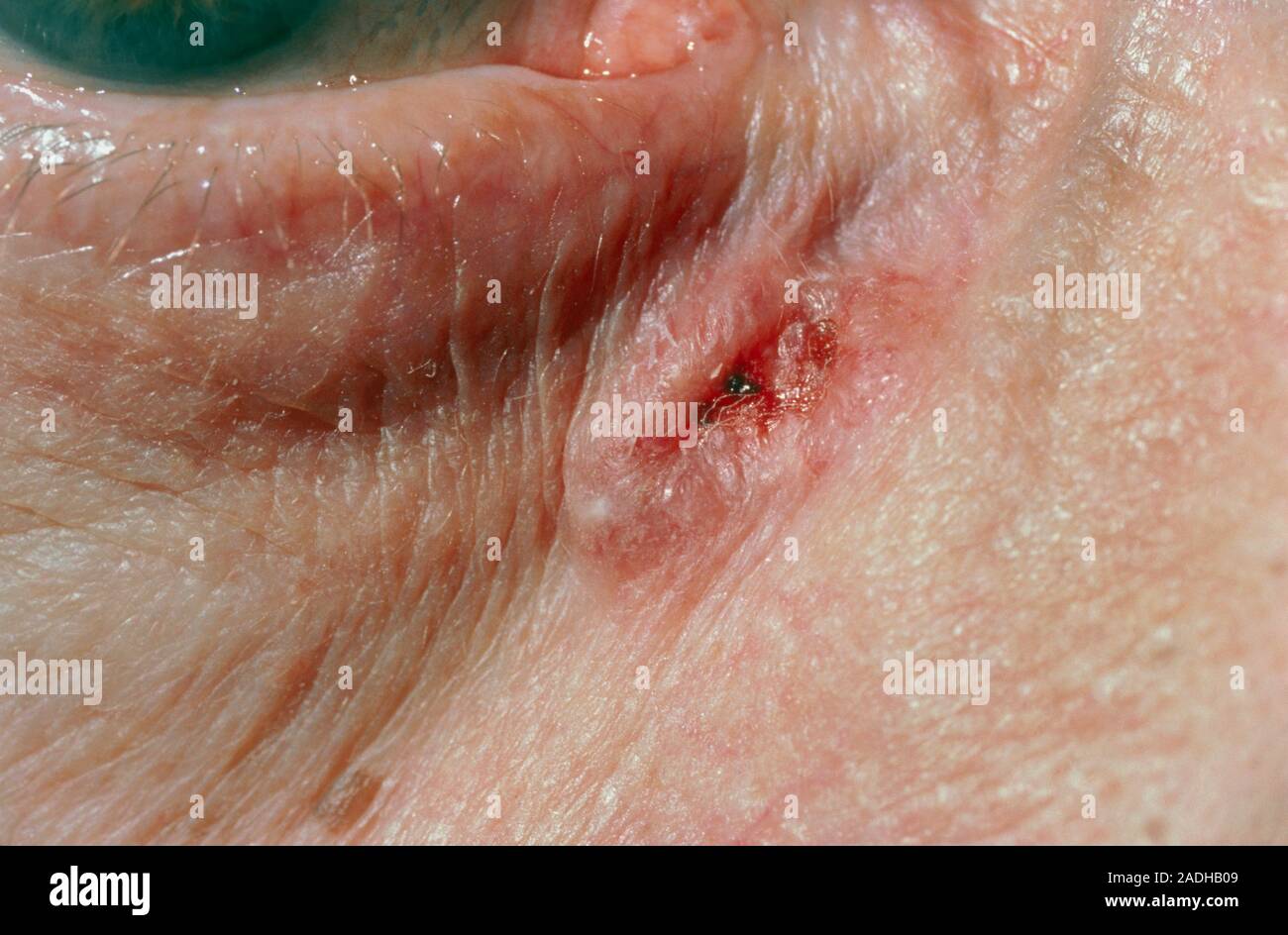 Rodent Ulcer Basal Cell Carcinoma Affecting The Skin Near The Eye