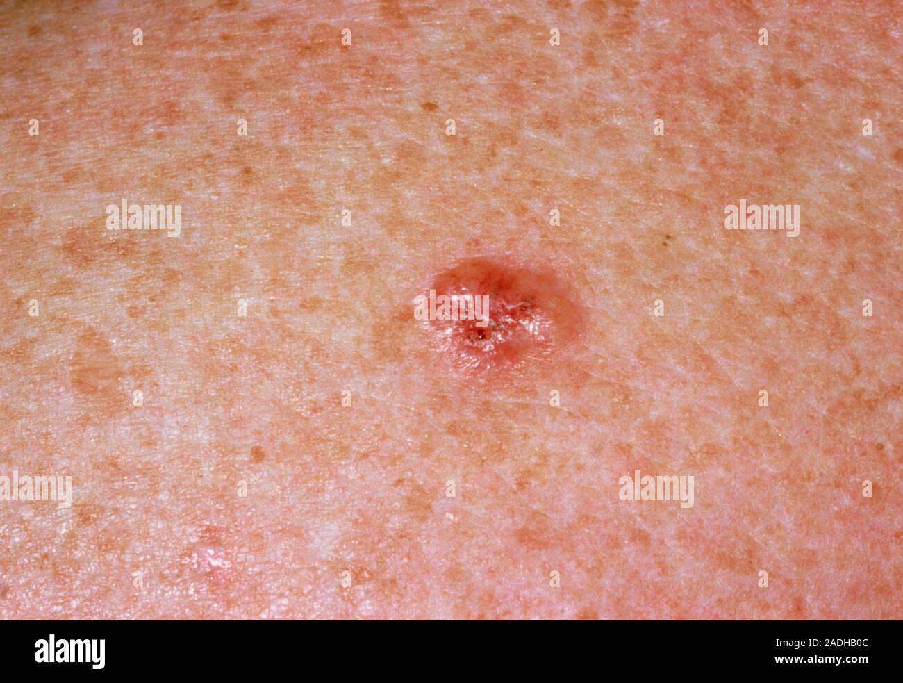 Basal cell carcinoma. This is a type of skin cancer also known as a