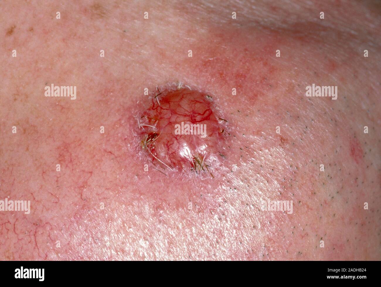 Basal cell carcinoma. View of a red, raised ulcer like growth, called