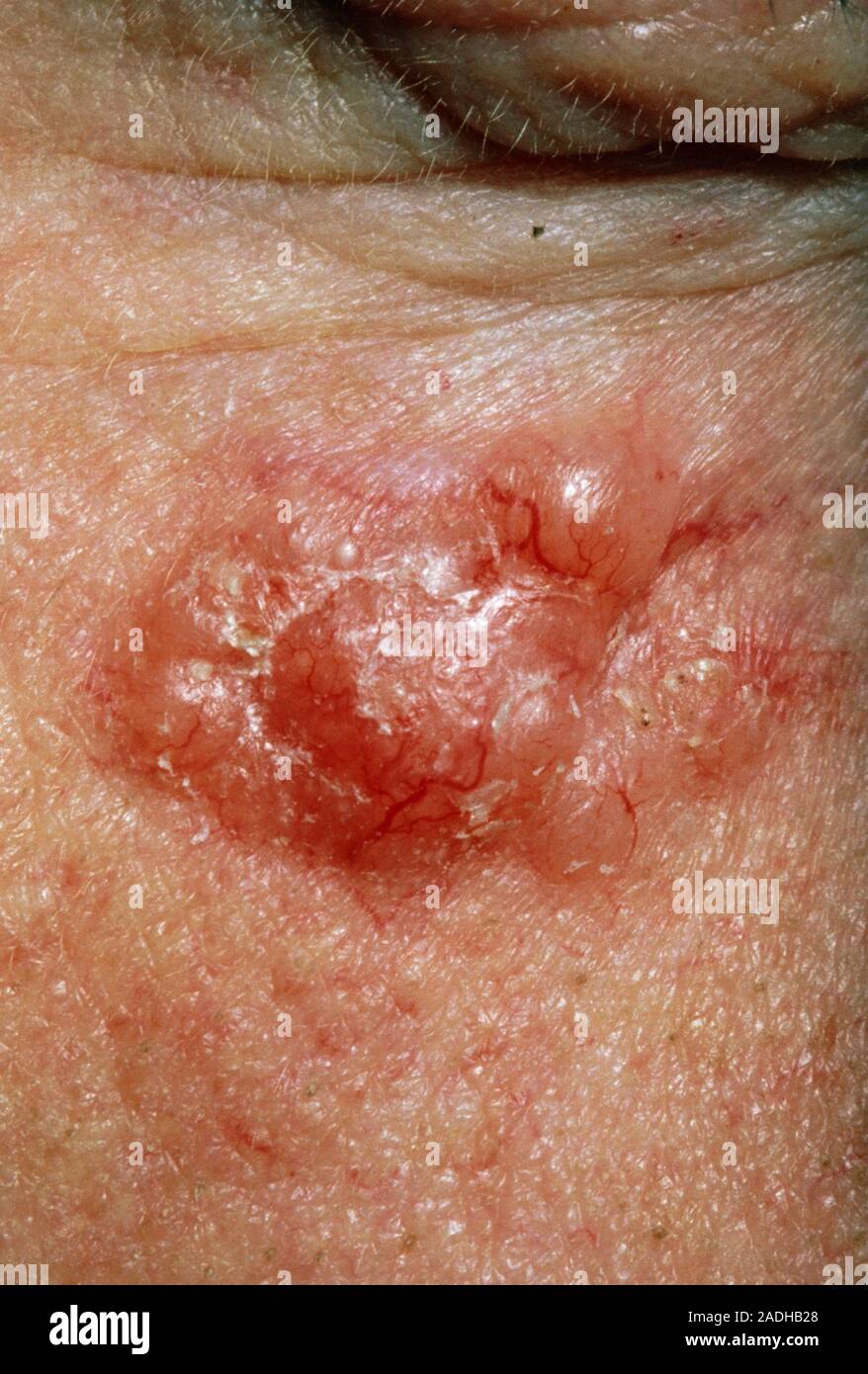 Basal cell carcinoma. A red, raised ulcerlike growth called a basal