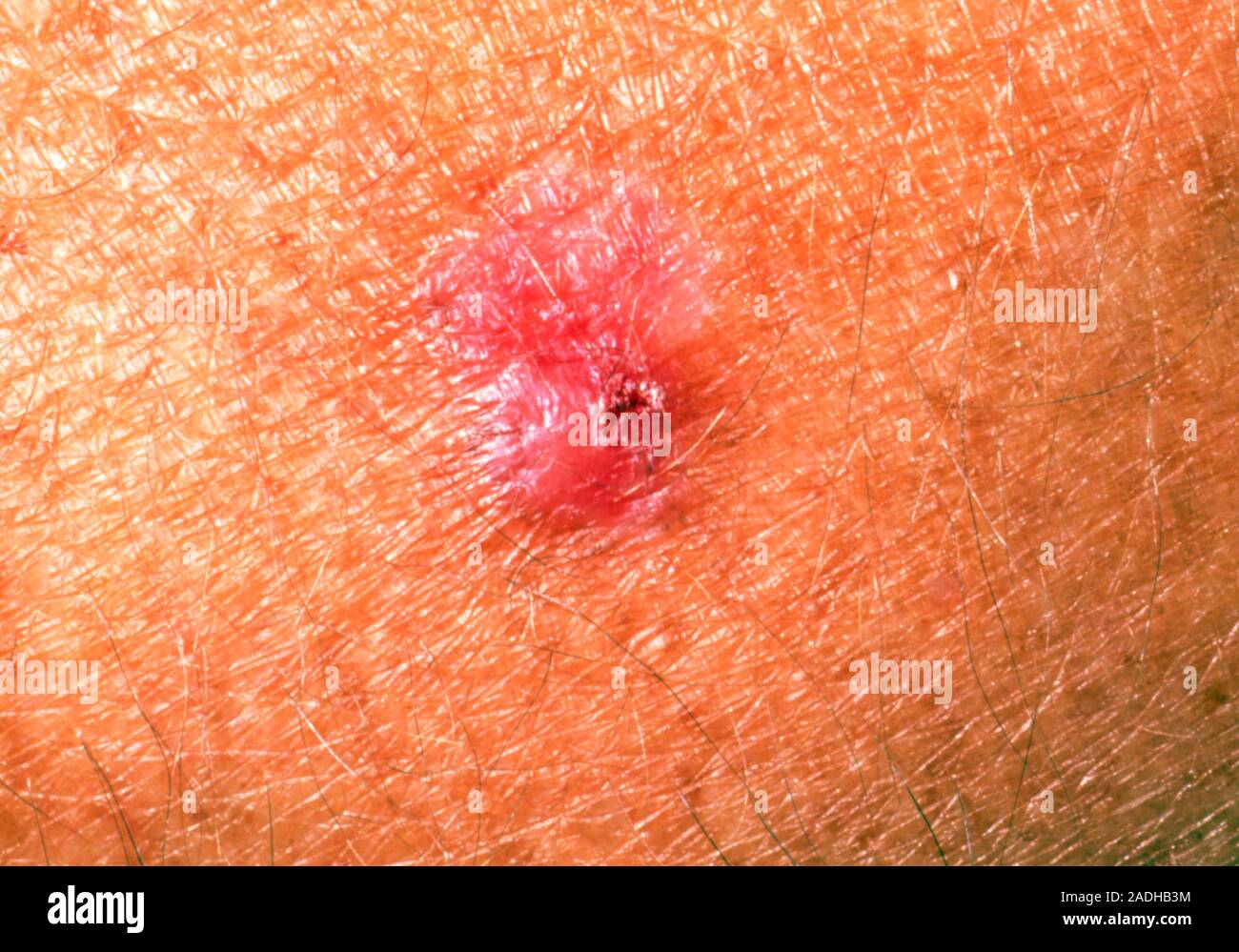 Basal cell carcinoma. View of a basal cell carcinoma (or rodent ulcer
