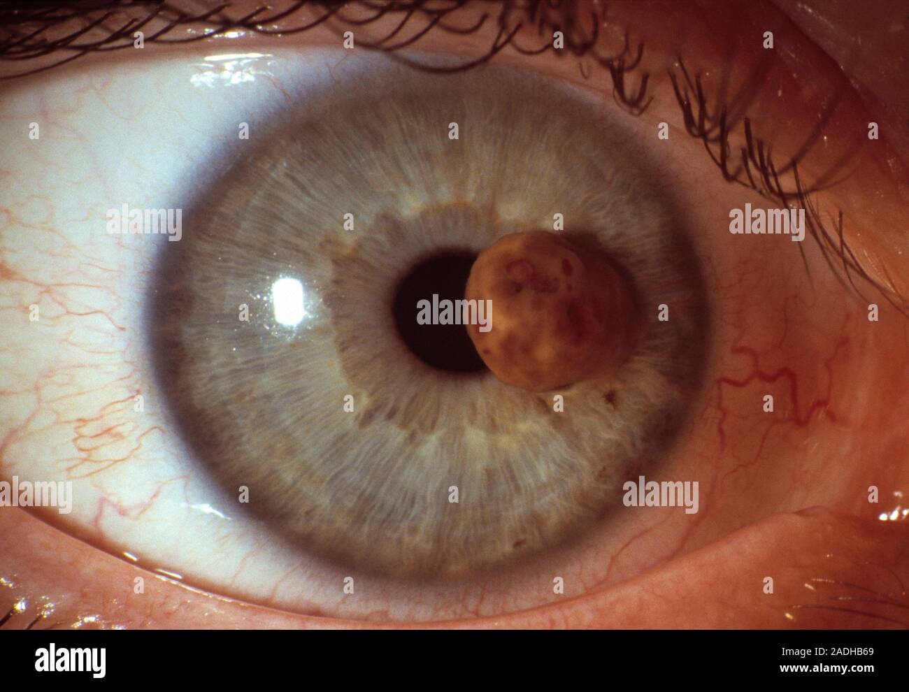 Malignant melanoma. Closeup of a malignant melanoma (cancer) on the
