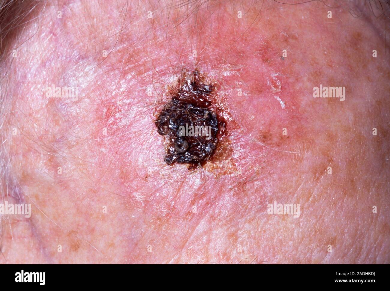 Skin Cancer On Forehead Look Like skin-cancer-on-forehead-look-like
