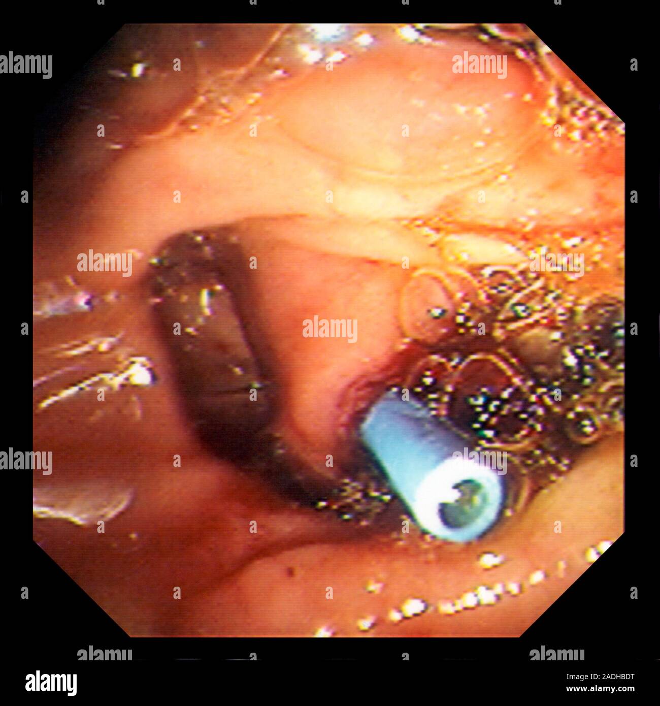 Gall bladder stent. Endoscope view of a plastic stent (blue) holding