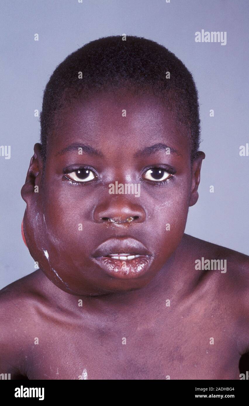 Burkitt's lymphoma cancer. Image 1 of 2. Front view of the face of a