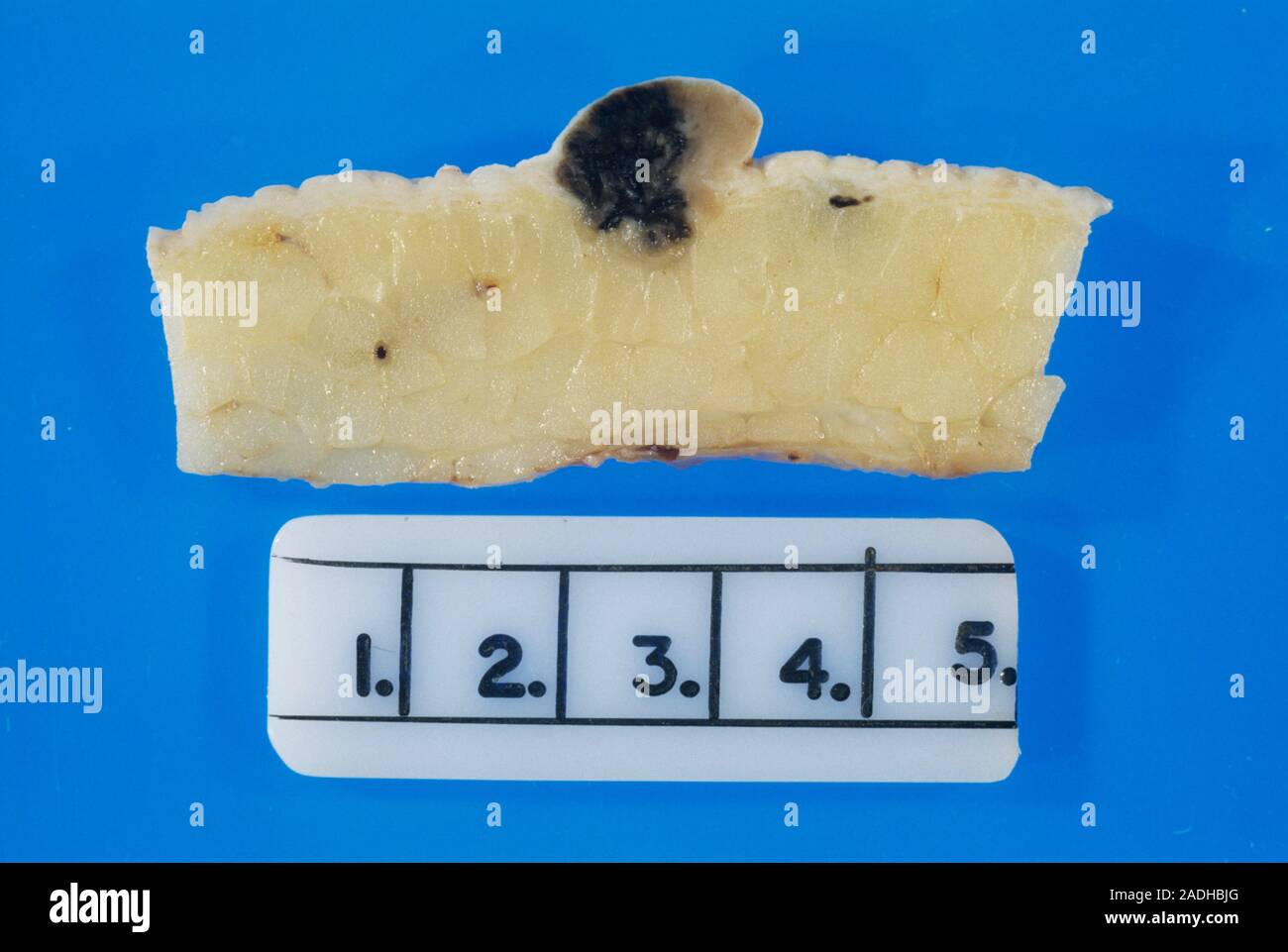 Skin cancer. Gross specimen of a malignant melanoma (dark area), a type ...