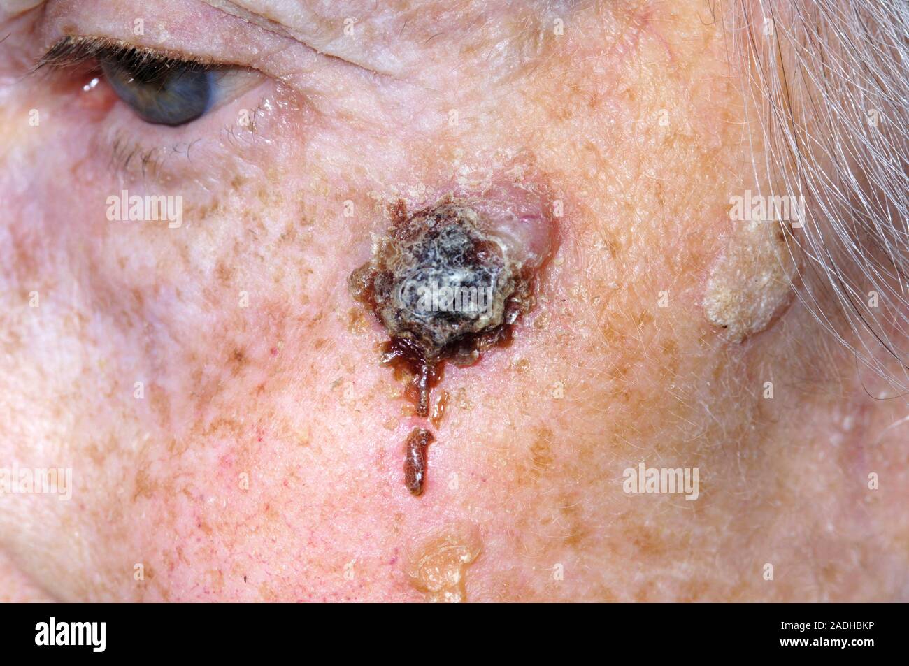 Skin cancer. Basal cell carcinoma (BCC), or rodent ulcer, on a 68 year old woman's back. This is
