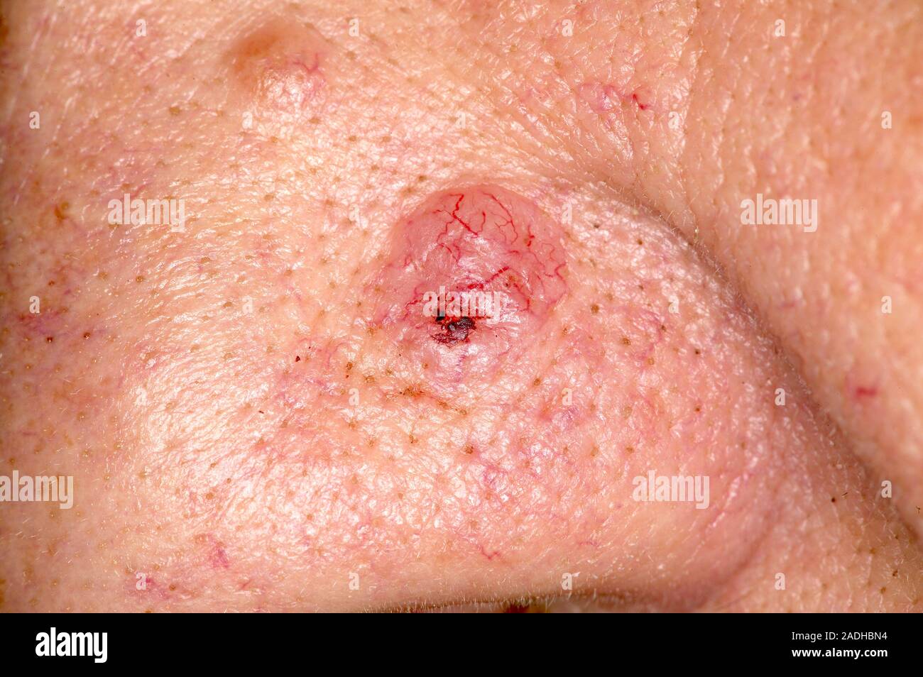 MODEL RELEASED. Basal cell carcinoma (BCC), or rodent ulcer, on a patient's nose. This is the most common form of skin cancer among fair-skinned peopl Stock Photo