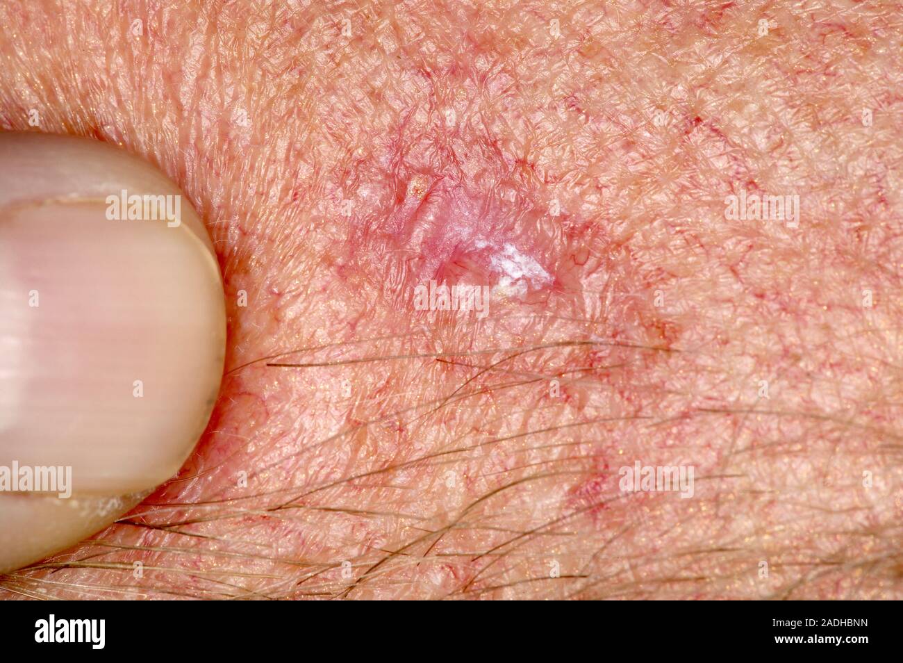 Model Released Basal Cell Carcinoma Bcc Or Rodent Ulcer On A