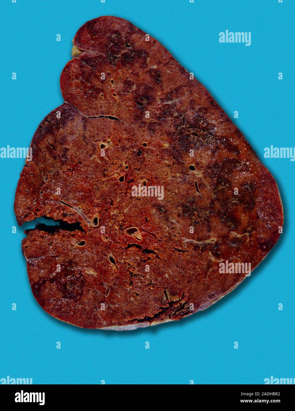 Spleen in myeloproliferative disease. Gross specimen of an enlarged