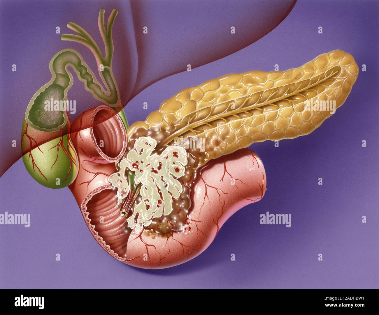 Панкреатит какой орган. Аденокарцинома поджелудочной железы. Глюкагонома поджелудочной железы. Цистаденокарцинома поджелудочной. Тумор поджелудочной железы.