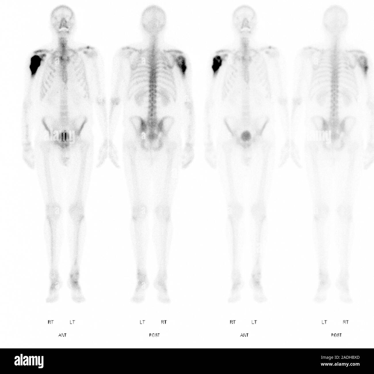 Bone cancer. Scintigrams (gamma scans) of a 51 year old man with a