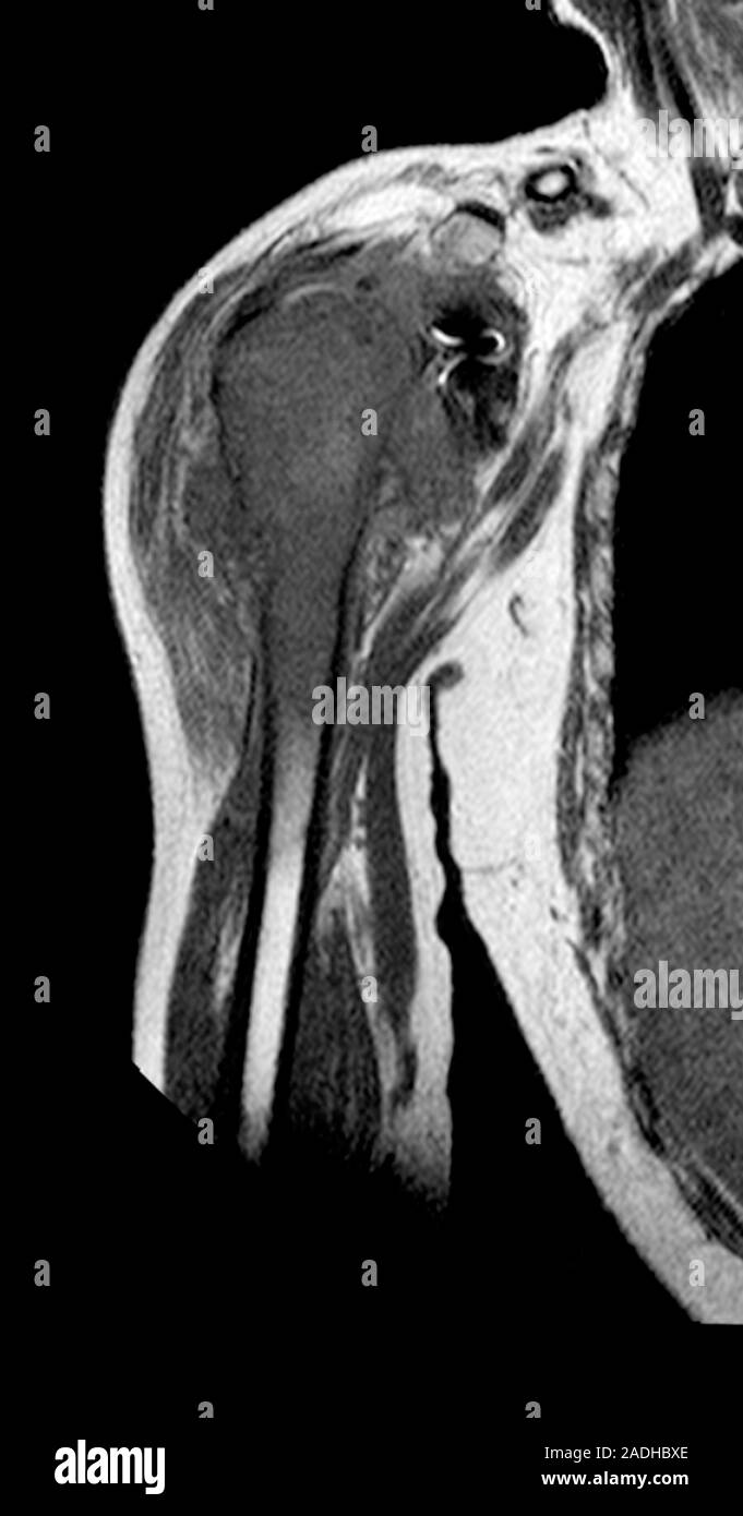 Bone cancer. MRI resonance imaging) scan of the right