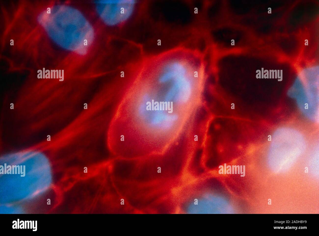 Fluorescence light micrograph showing numerous cancer cells the cell