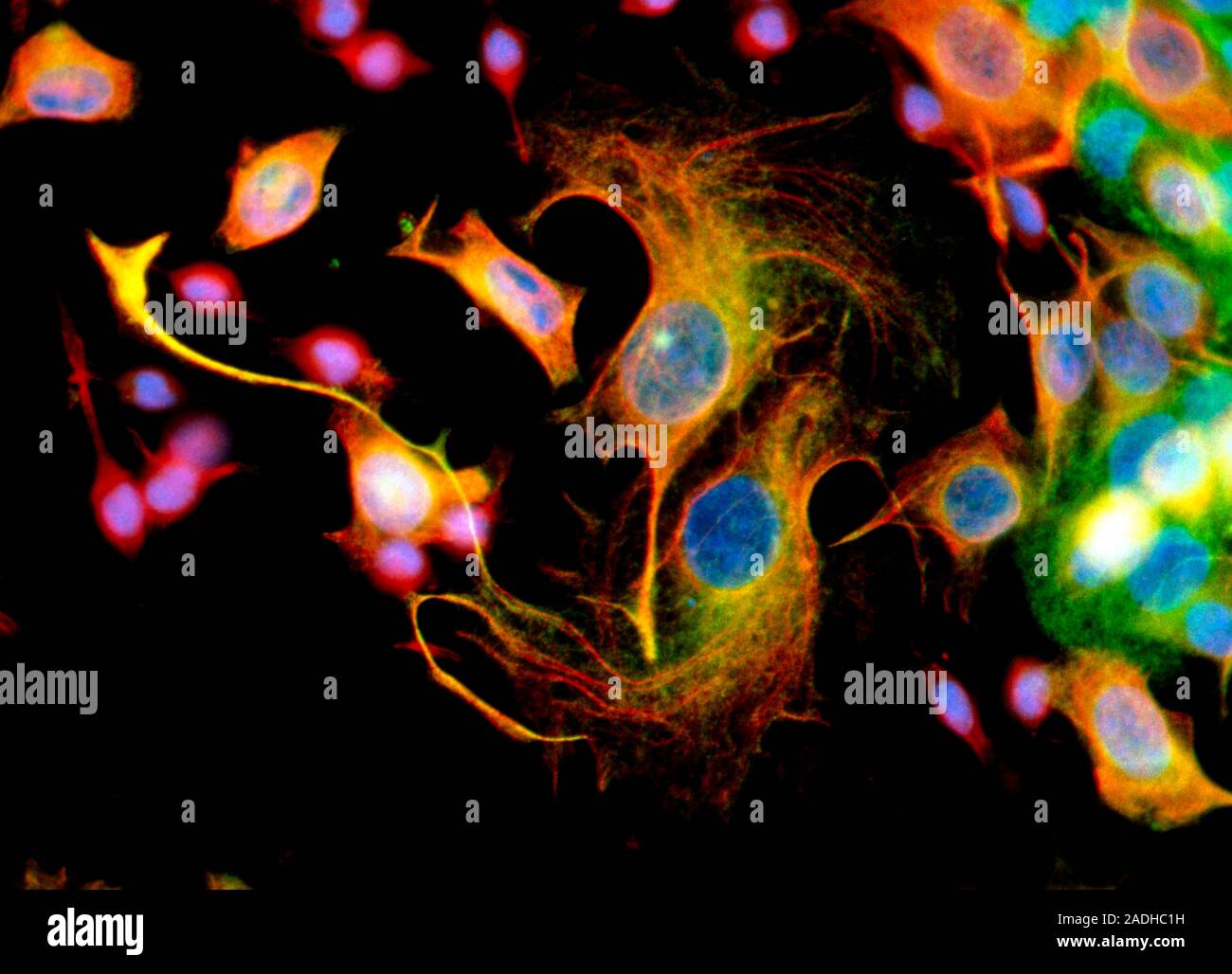 Immunofluorescent Light Micrograph of mixed human- cancer cells in a ...