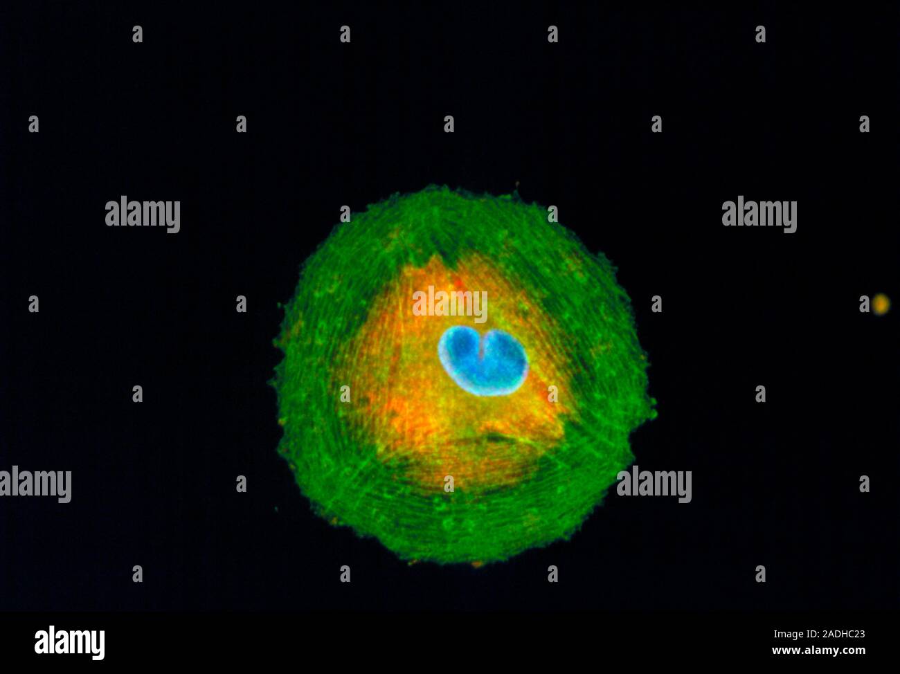 Melanoma cell. Immunofluorescent Light Micrograph of a melanoma cancer cell, cultured from a human tumour. The cell nucleus (blue) is in the process o Stock Photo