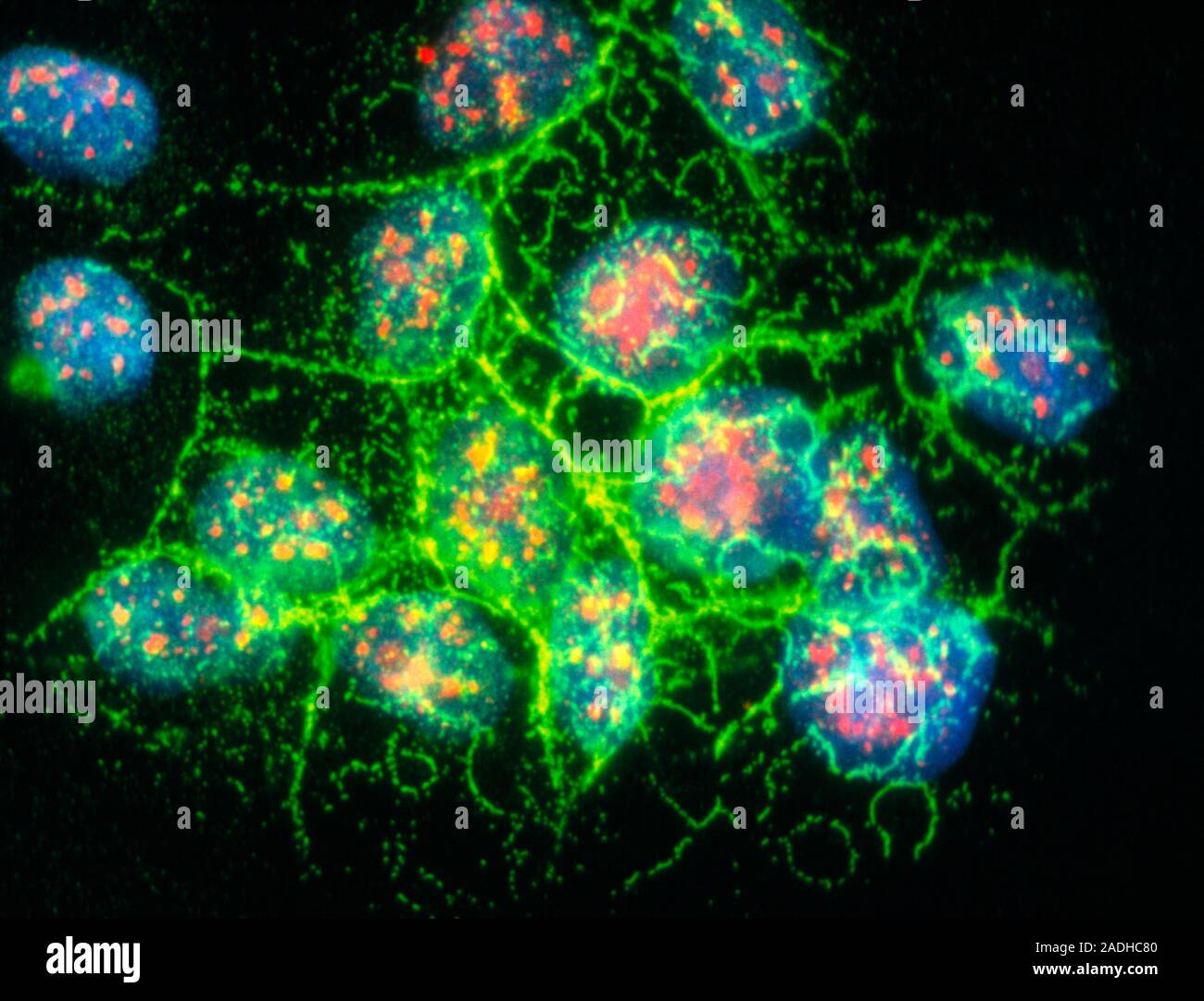Lung cancer cells. Immunofluorescent light micrograph of a culture of multidrugresistant lung