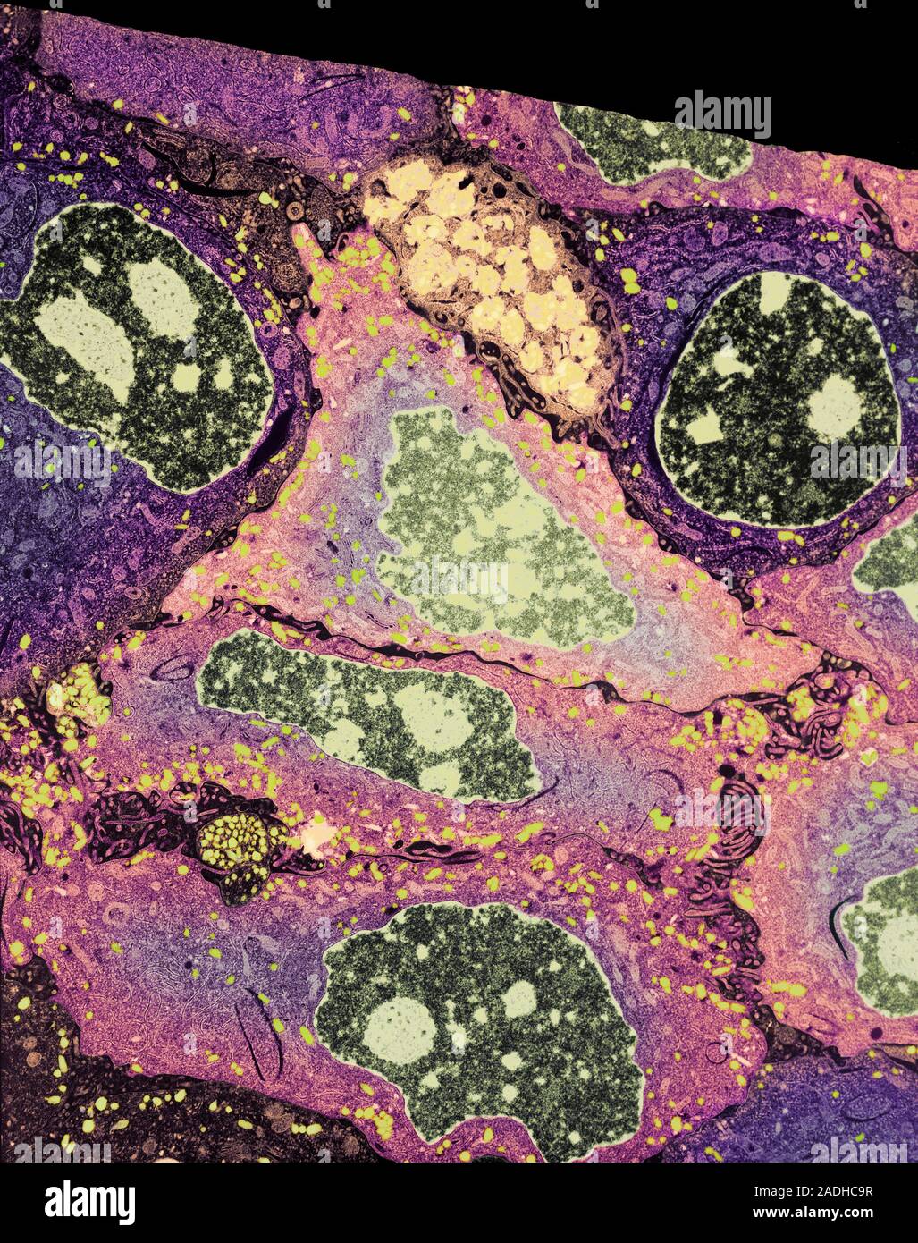 Melanoma cancer. Coloured transmission electron micrograph (TEM) of a ...