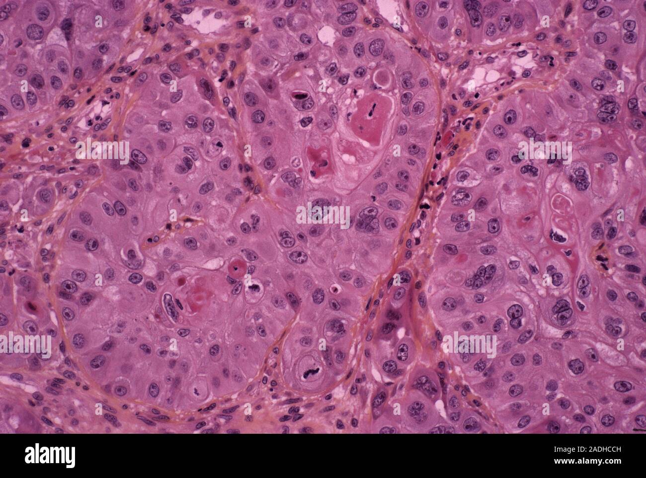 Oesophagus Cancer Light Micrograph Of A Section Through Cancer Or Oesophagus Cancer Light Micrograph Of A Section Through Cancer Or