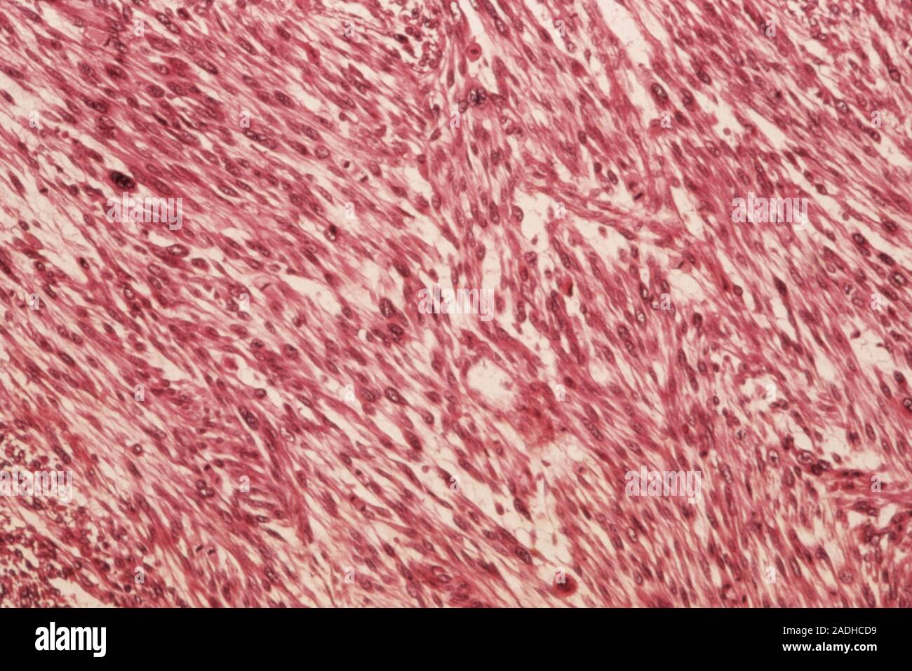 Cancer of the uterus. Light micrograph of a section through a uterine are