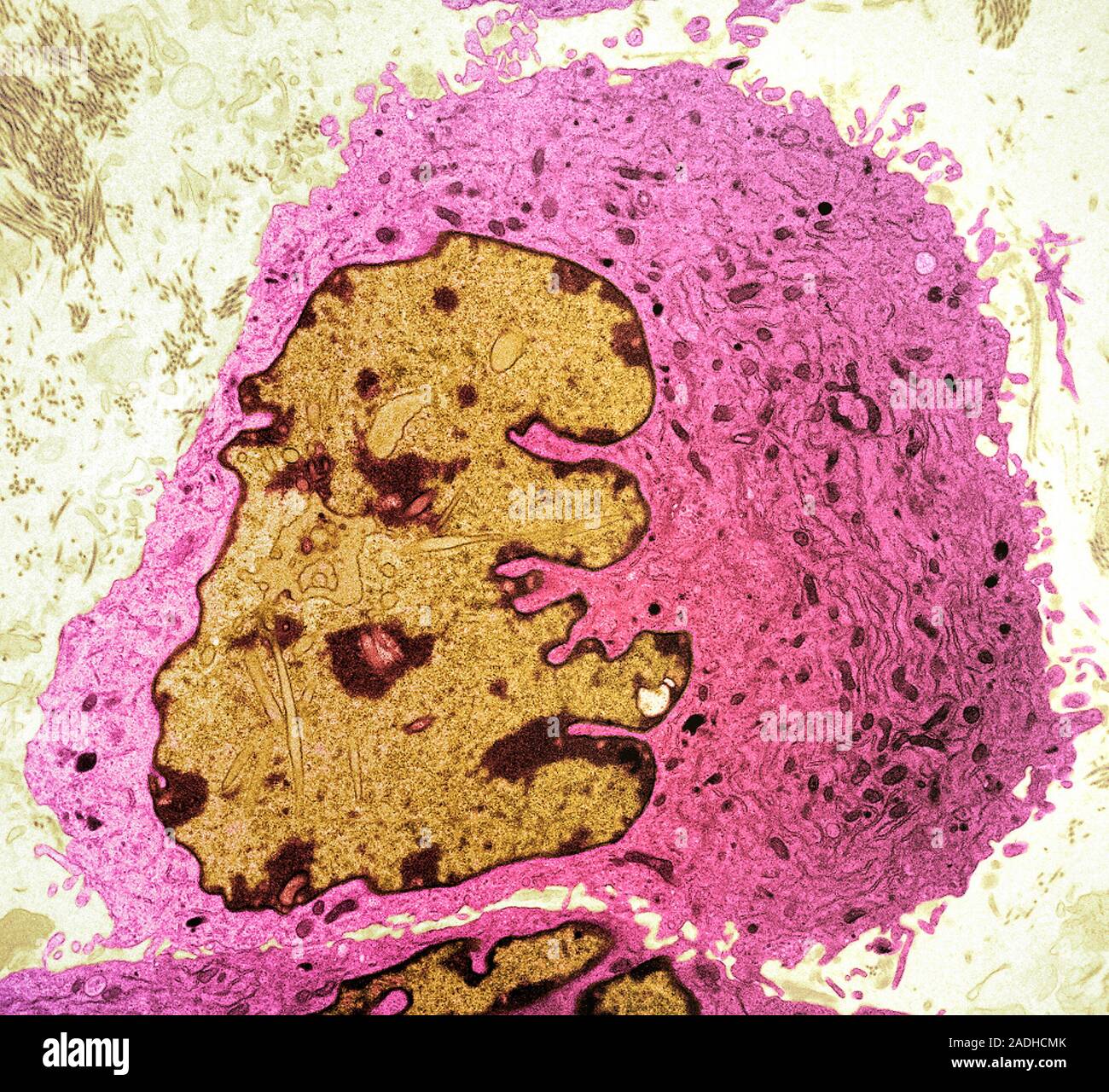 Sarcoma Cell Coloured Transmission Electron Micrograph Of A Sarcoma