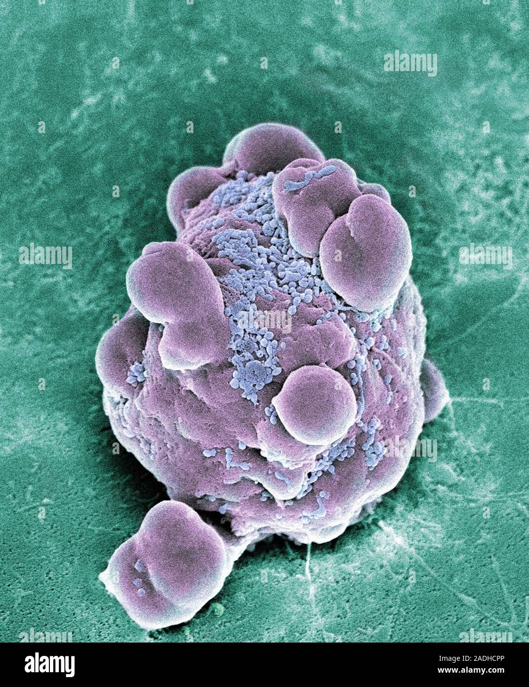 Cancer cell apoptosis. Coloured scanning electron micrograph (SEM) of a ...