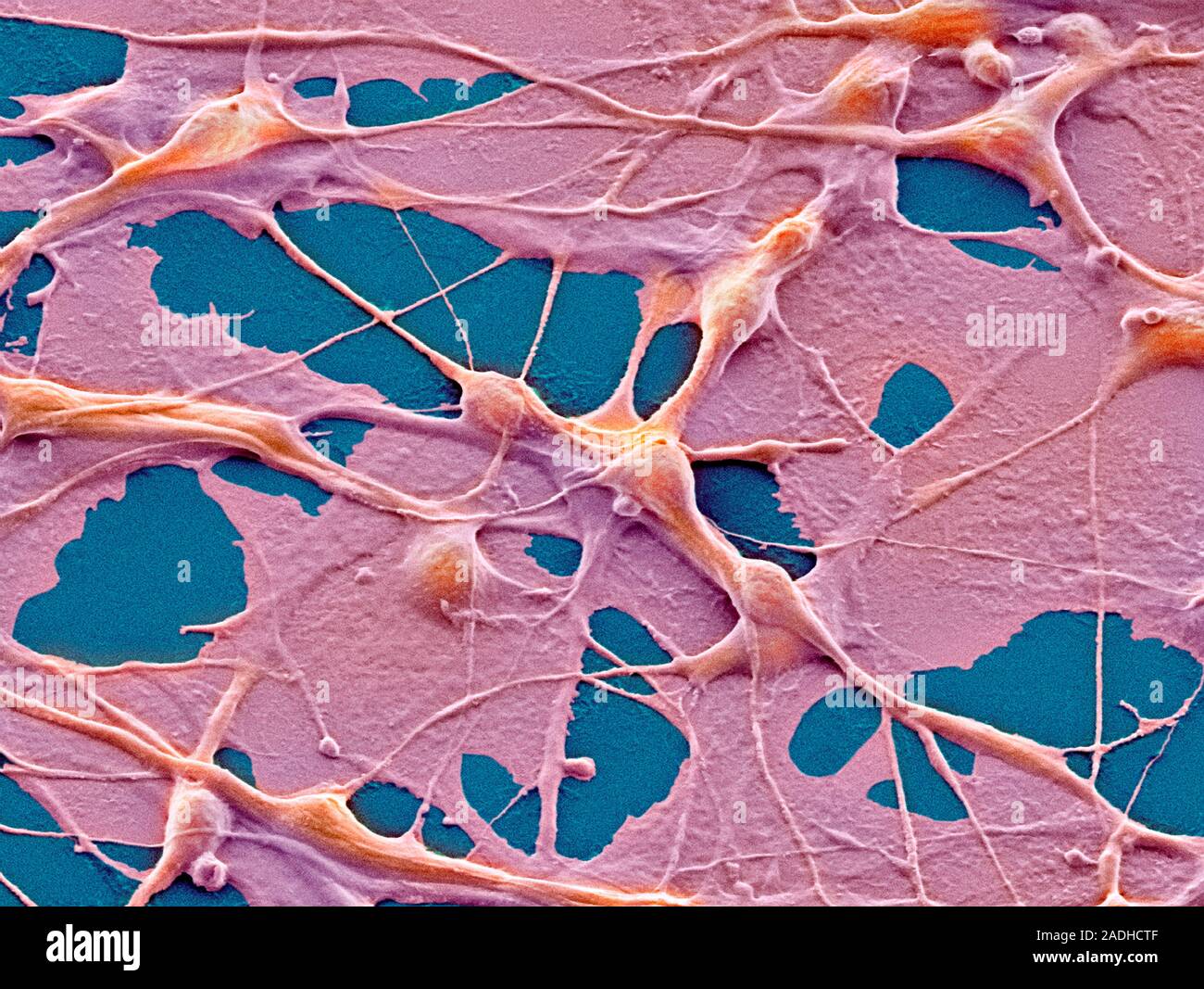 Teratoma cancer cells. Coloured scanning electron micrograph (SEM) of ...