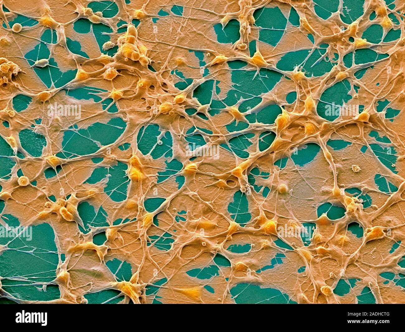 Teratoma cancer cells. Coloured scanning electron micrograph (SEM) of ...