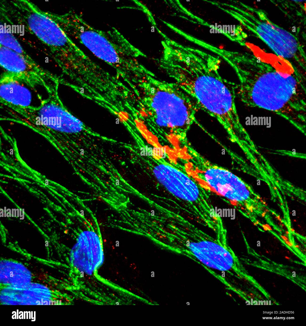 Brain protein in cancer research, fluorescence deconvolution micrograph