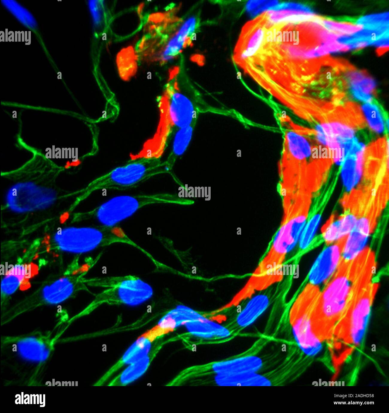Brain protein in cancer research, fluorescence deconvolution micrograph