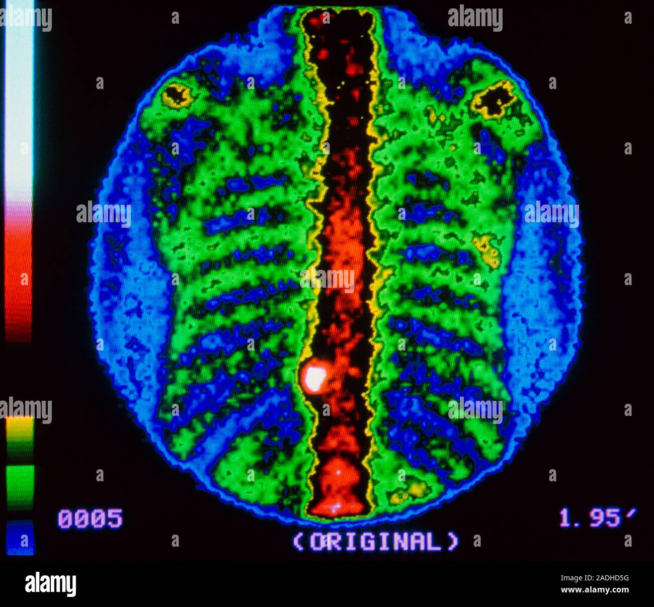 False colour bone scintigram of the spine and ribs of a person ...