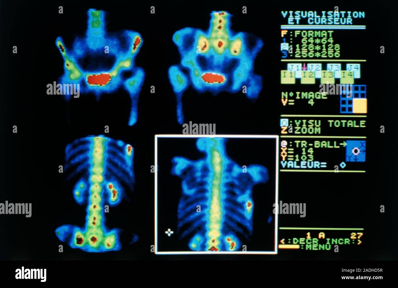Gamma camera scans of a person suffering from multiple metastastic