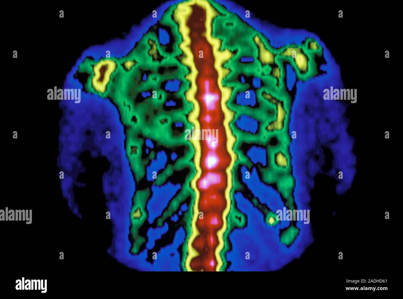 Falsecolour scintigram (bone scan) of the human spine and ribs