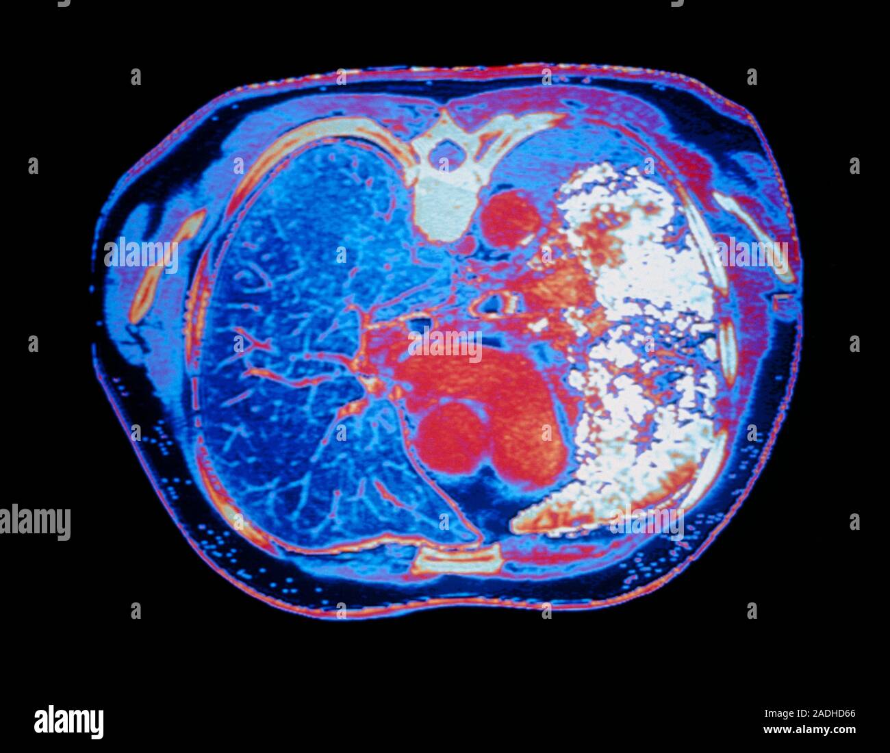 False colour computed X-ray tomography (CT) scan of the chest of a man ...
