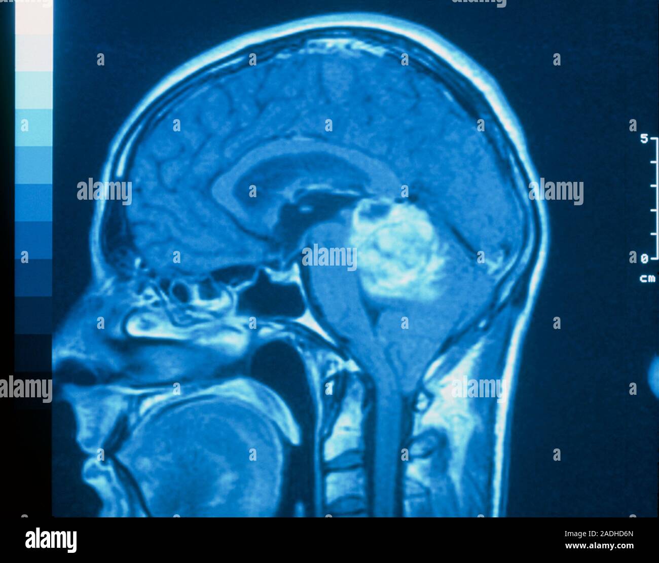Brain 254. Опухоль головного мозга рентген. Опухоль головного мозга рентген в руках. Доброкачественная опухоль мозга.