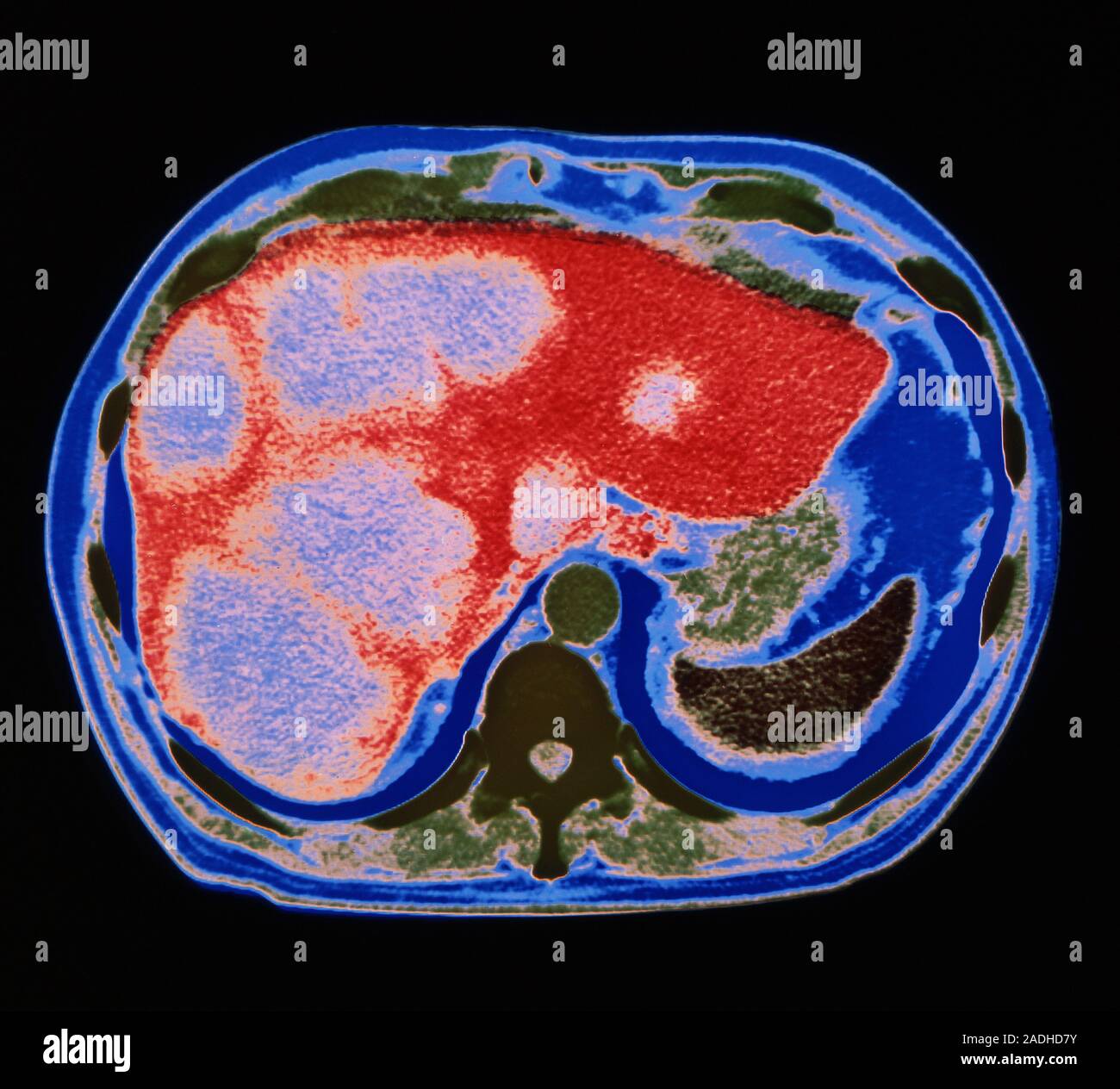 Liver cancer. Coloured computed tomography (CT) scan of an axial