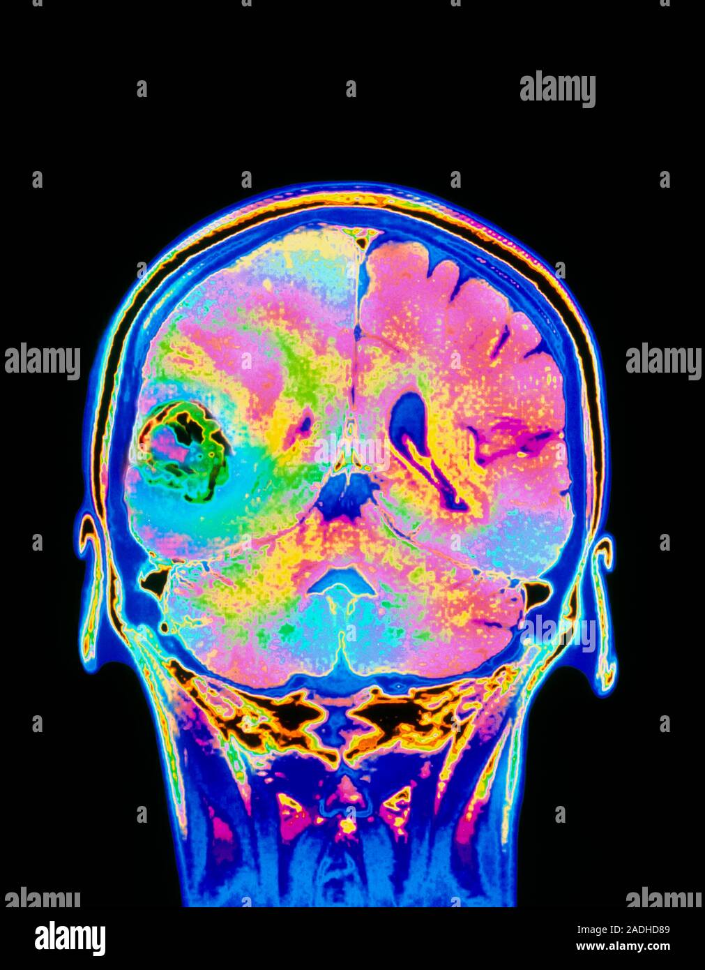 Brain tumour. Coloured Magnetic Resonance Imaging (MRI) scan of a ...